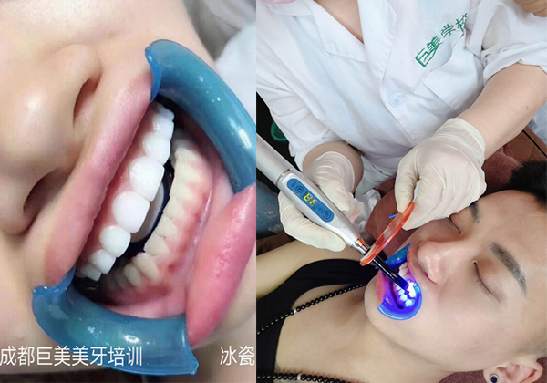 那里有招生美牙贴面的