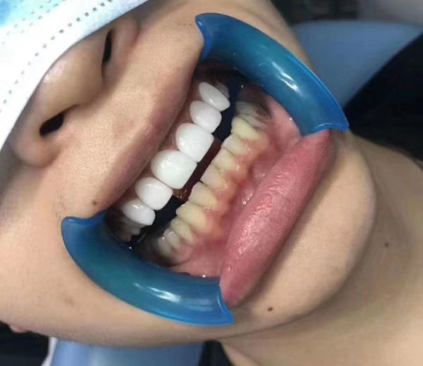 离子高光牙齿美白好吗