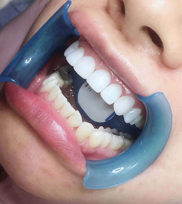 罕见的牙齿美白体例优错误谬误