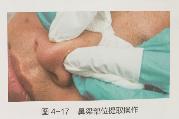手动提取黑头粉刺的体例